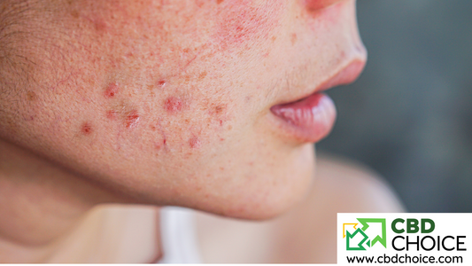 CBD and Acne: How to Harness Its Benefits for Clearer Skin